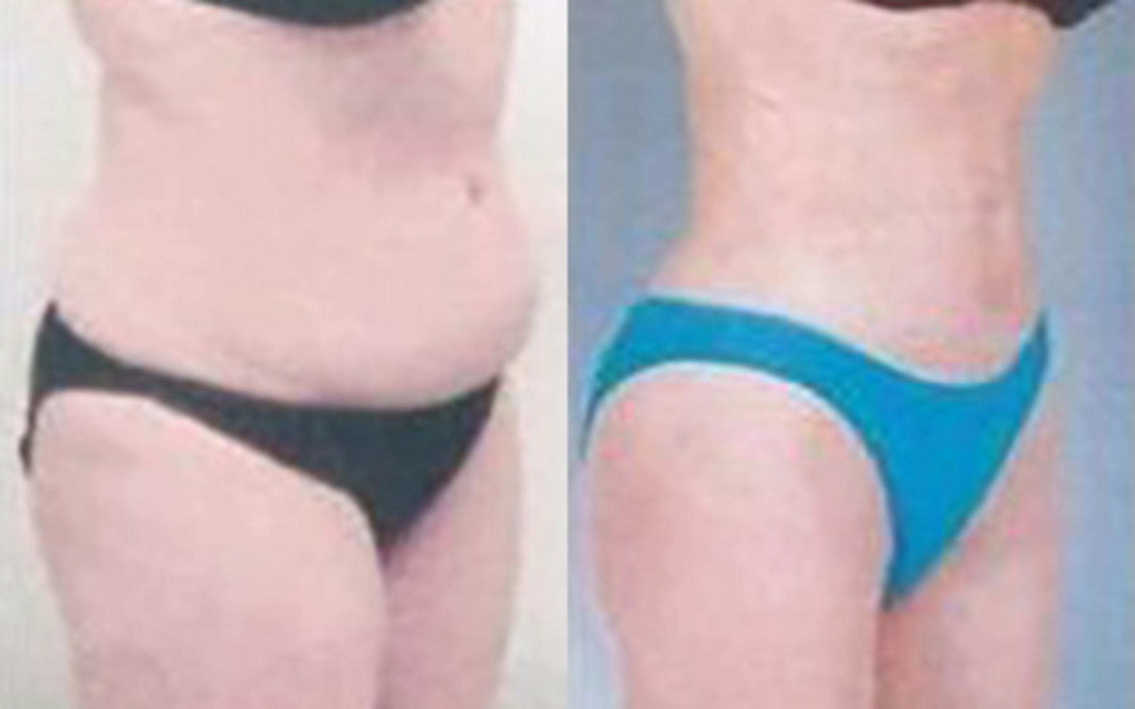 Before & After Liposuction Case 3505 View 2 View in Houston, TX