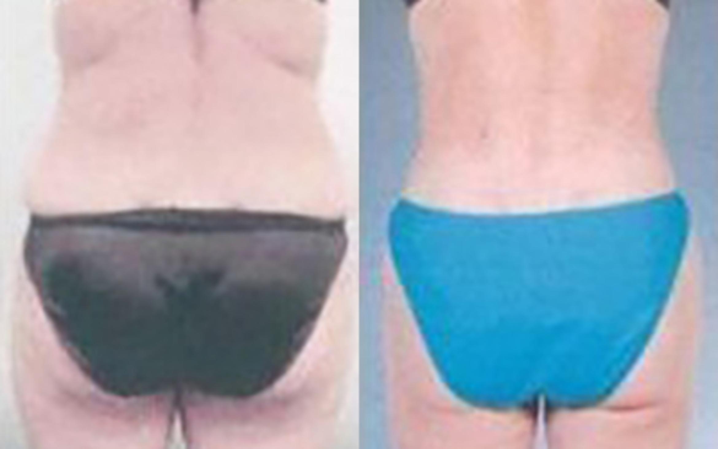 Before & After Liposuction Case 3505 View 3 View in Houston, TX