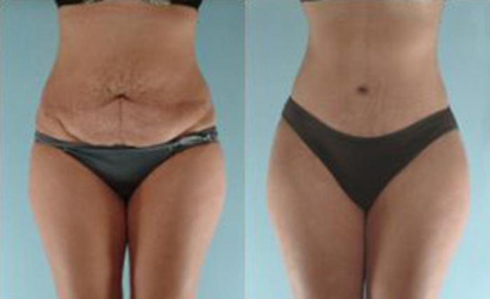 Before & After Liposuction Case 3513 View 1 View in Houston, TX