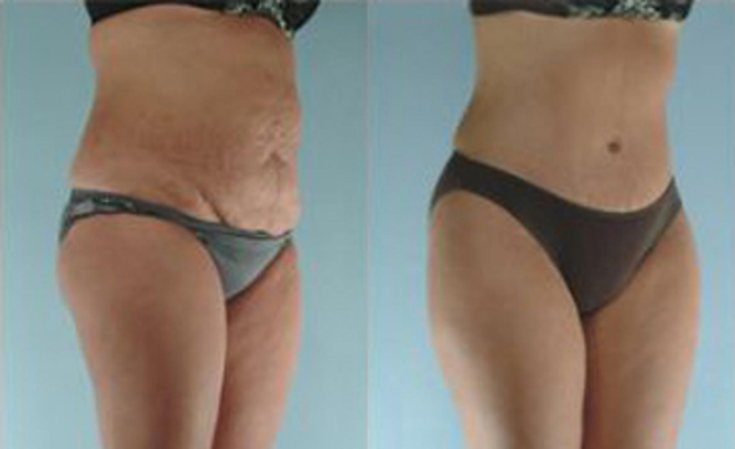 Before & After Liposuction Case 3513 View 2 View in Houston, TX