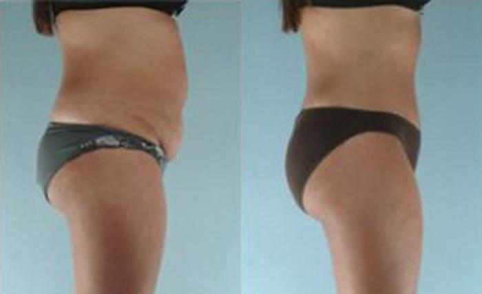 Before & After Liposuction Case 3513 View 3 View in Houston, TX