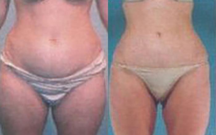 Before & After Liposuction Case 3521 View 1 View in Houston, TX