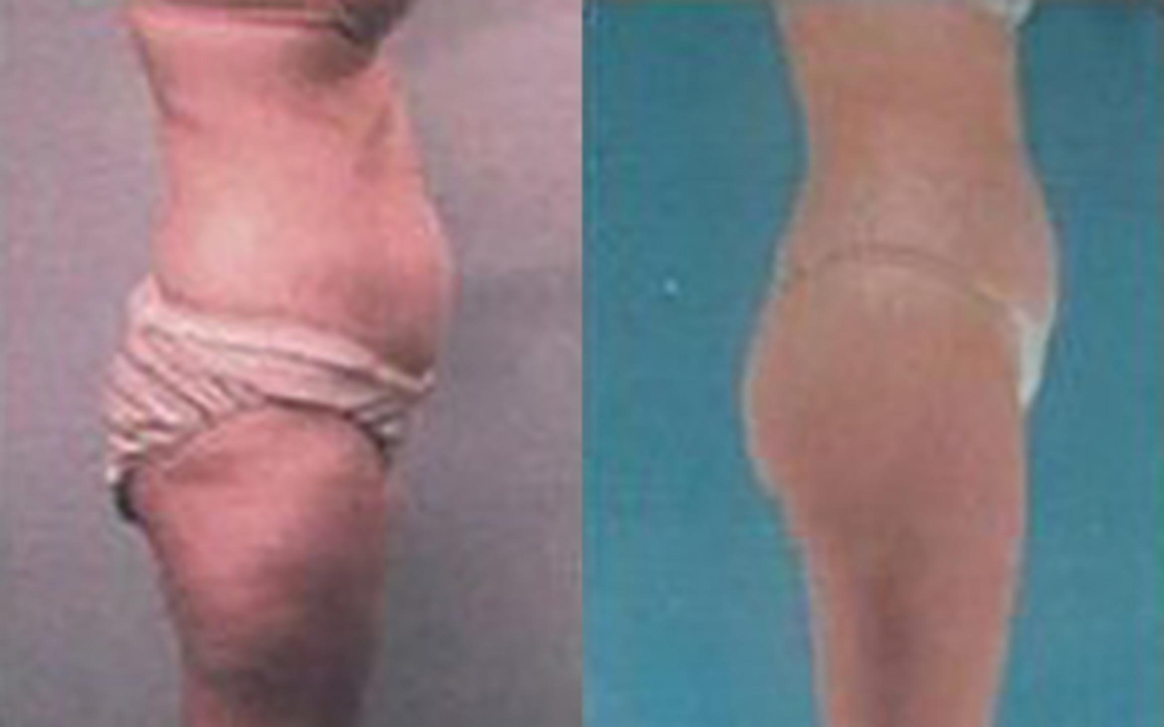 Before & After Liposuction Case 3521 View 2 View in Houston, TX