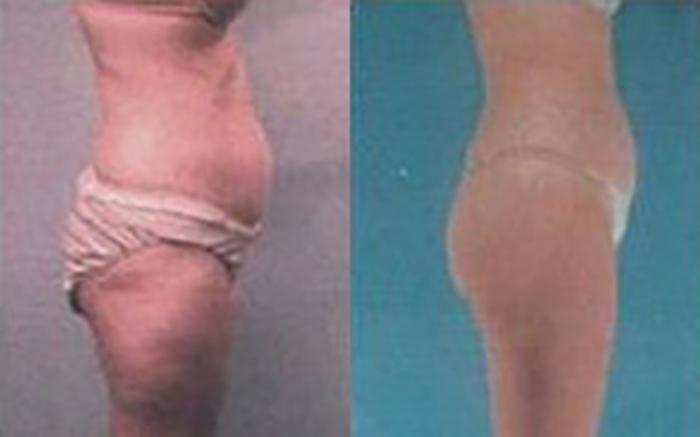 Before & After Liposuction Case 3521 View 2 View in Houston, TX