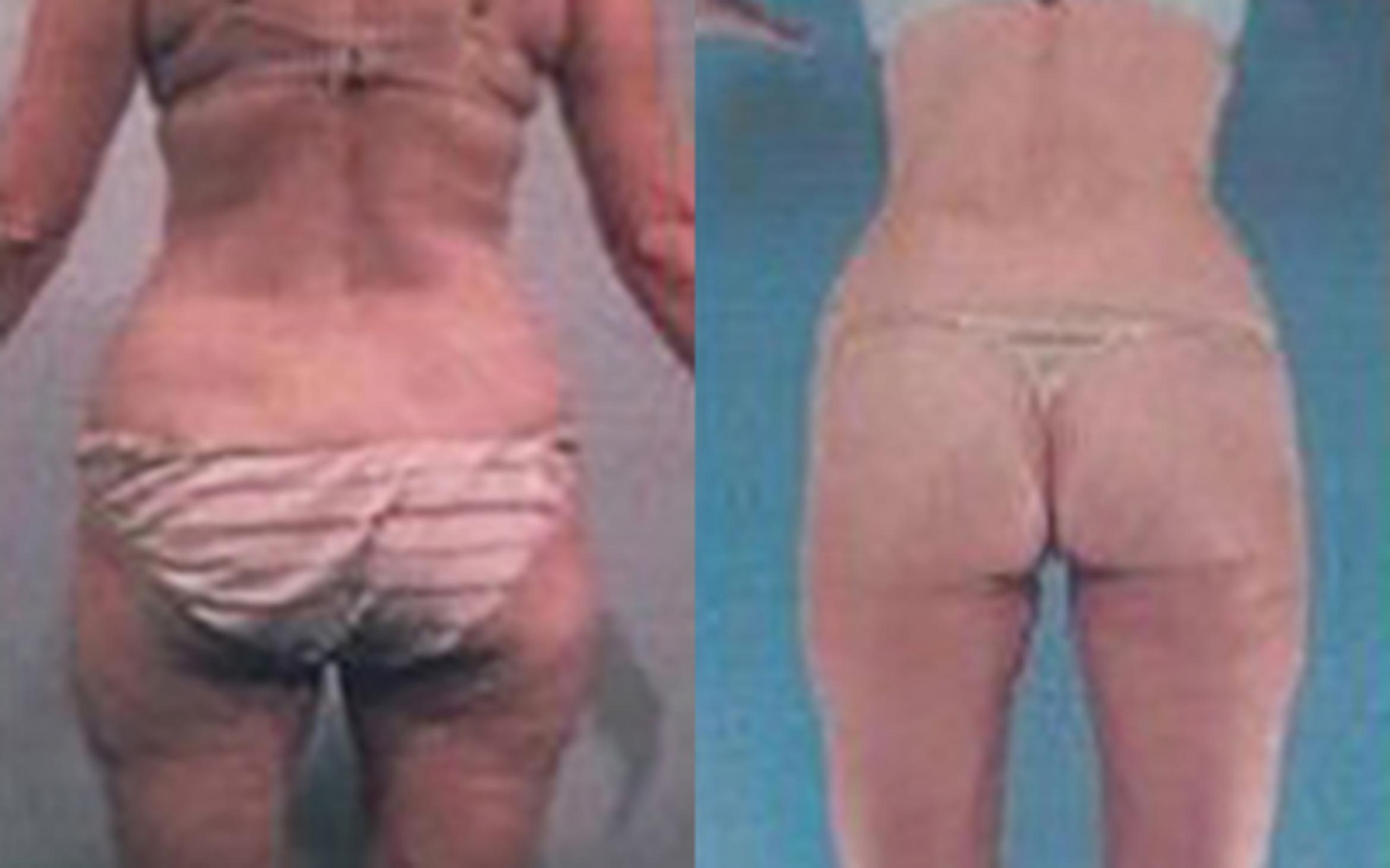 Before & After Liposuction Case 3521 View 3 View in Houston, TX