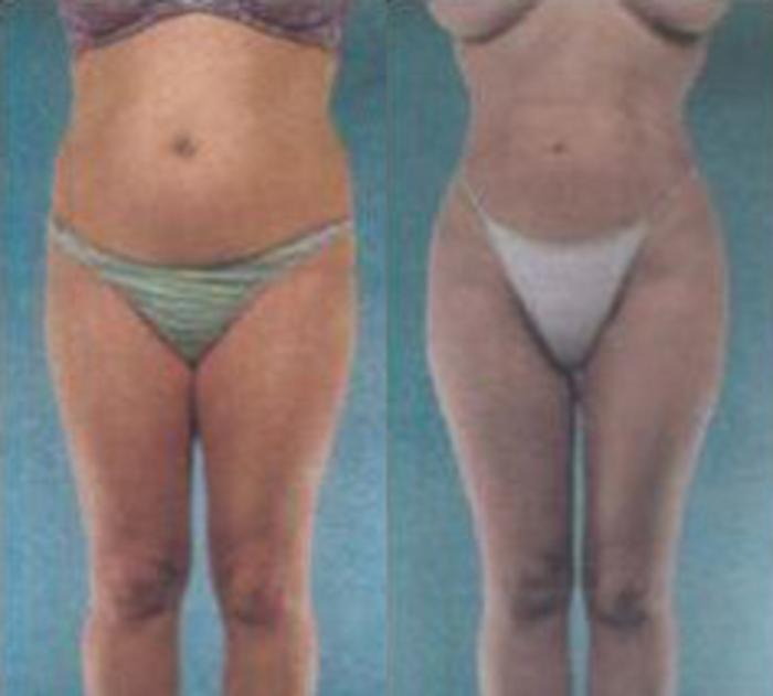 Before & After Liposuction Case 3529 View 1 View in Houston, TX