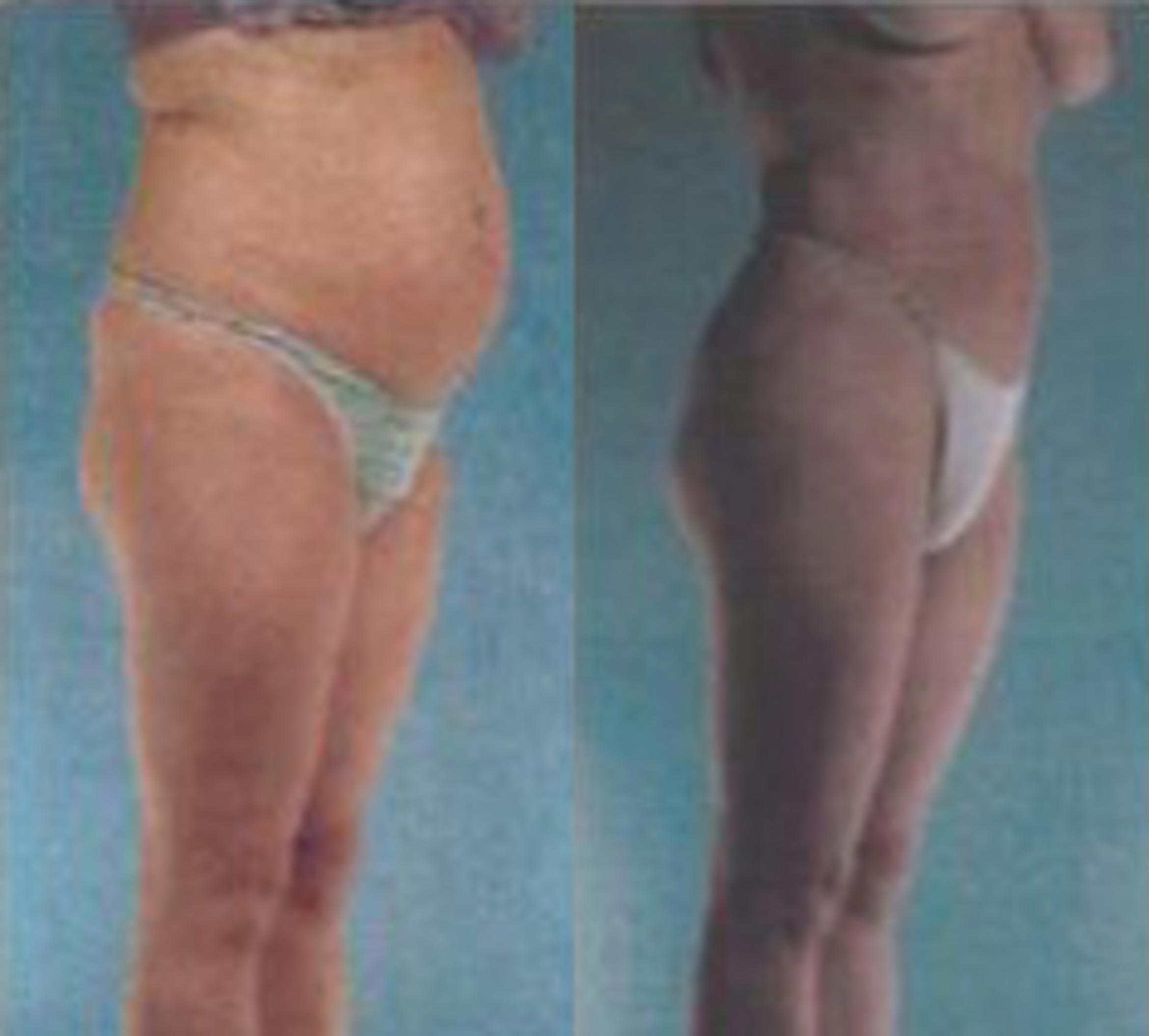 Before & After Liposuction Case 3529 View 2 View in Houston, TX