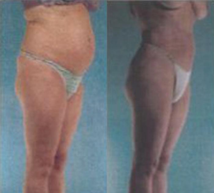 Before & After Liposuction Case 3529 View 2 View in Houston, TX
