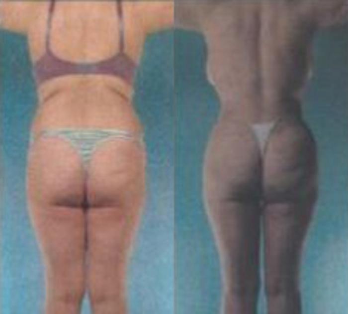 Before & After Liposuction Case 3529 View 3 View in Houston, TX