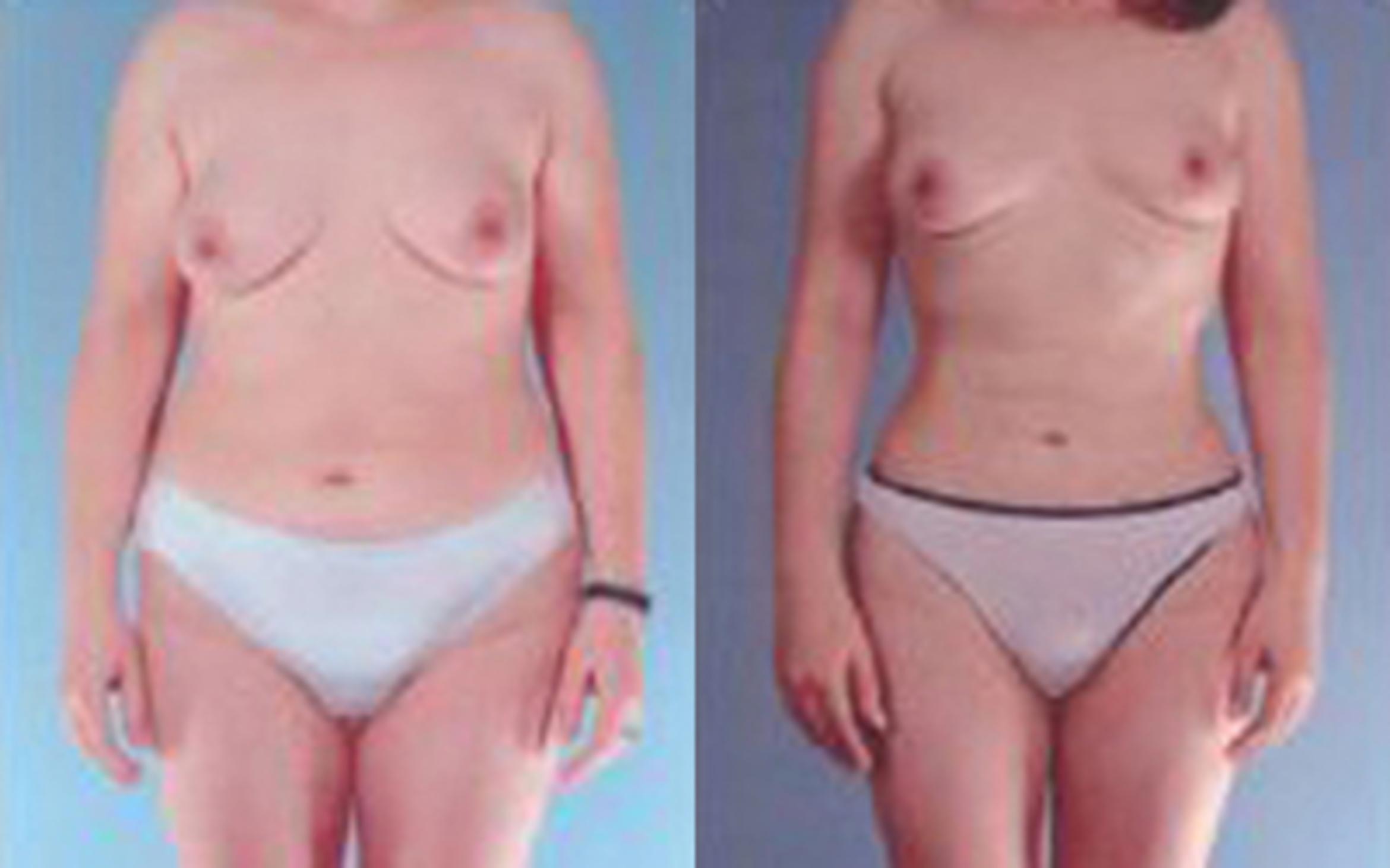 Before & After Liposuction Case 3537 View 1 View in Houston, TX