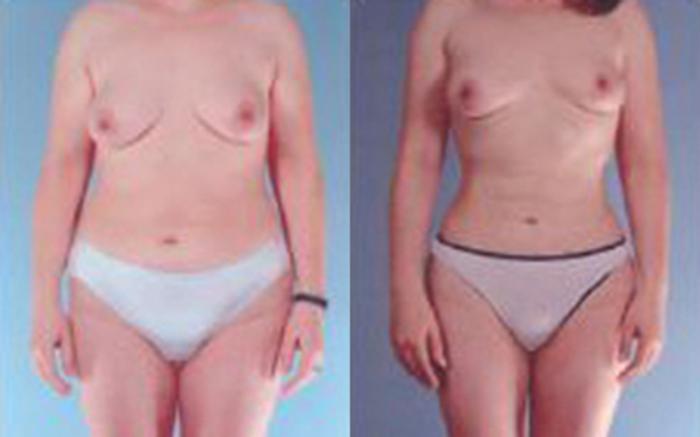 Before & After Liposuction Case 3537 View 1 View in Houston, TX