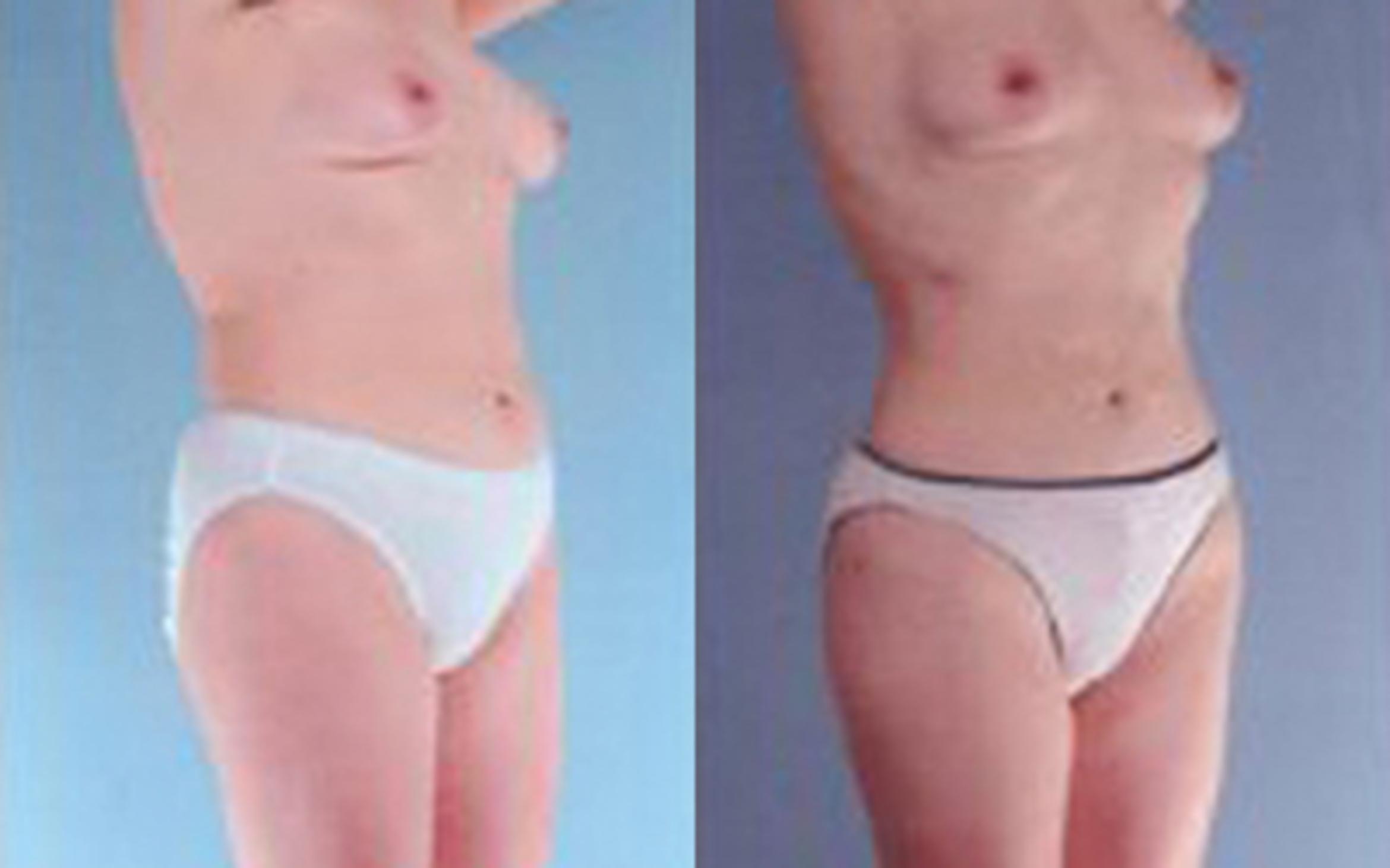 Before & After Liposuction Case 3537 View 2 View in Houston, TX