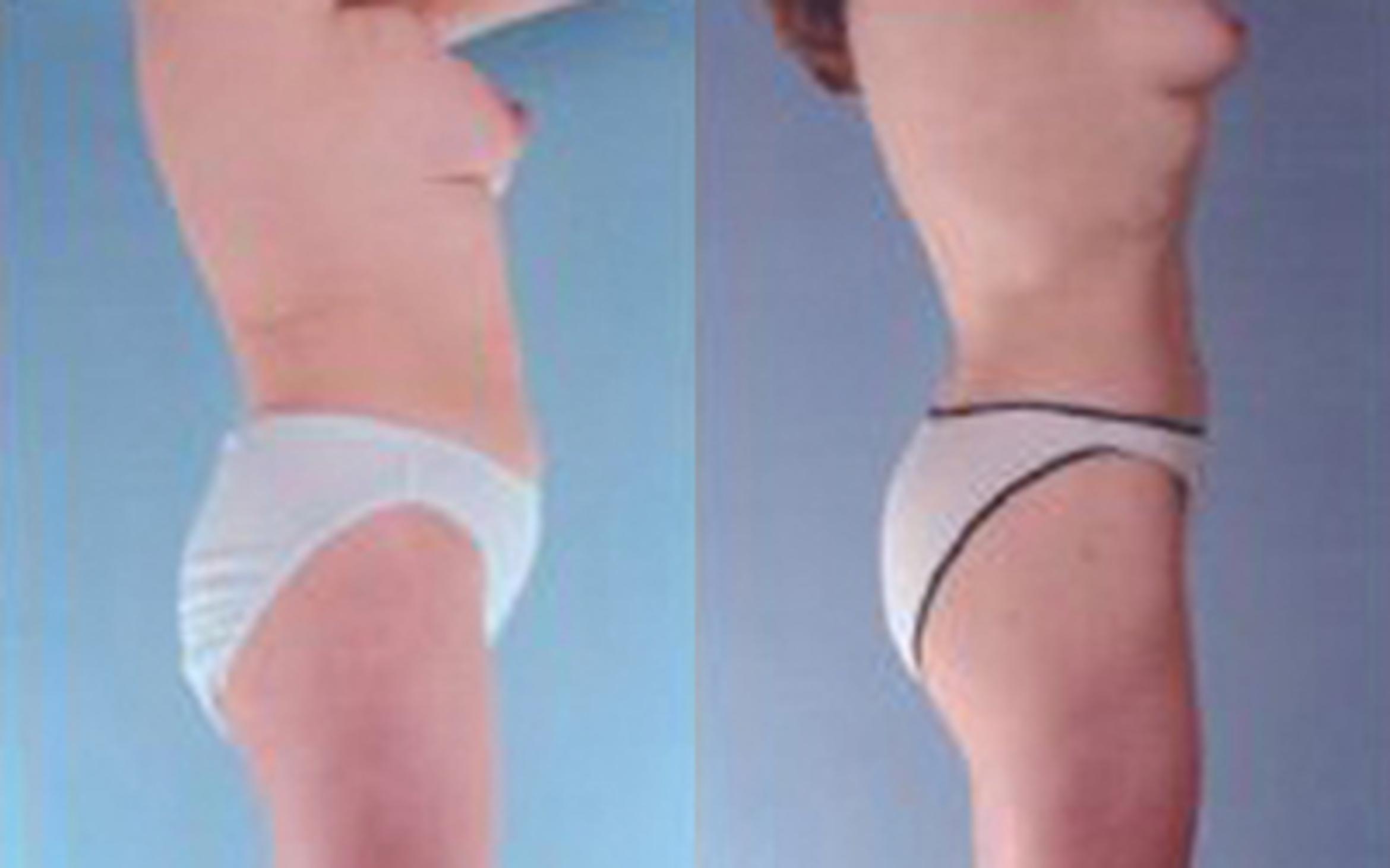 Before & After Liposuction Case 3537 View 3 View in Houston, TX