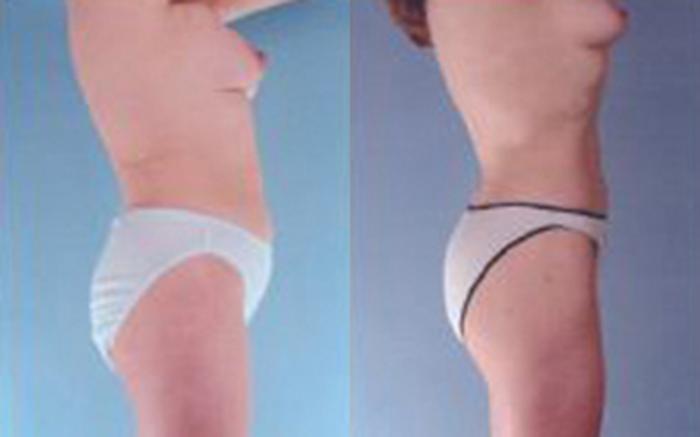 Before & After Liposuction Case 3537 View 3 View in Houston, TX