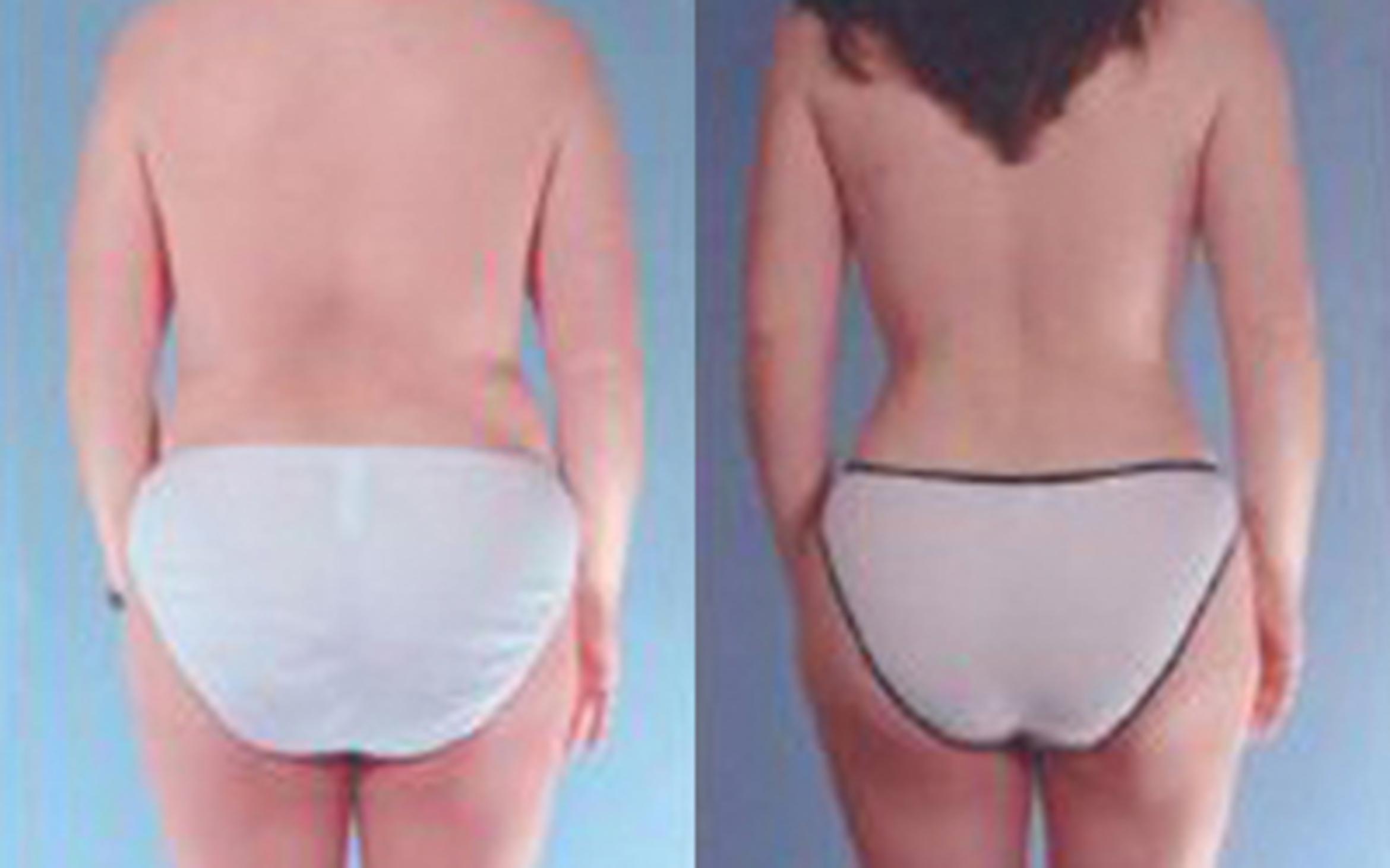 Before & After Liposuction Case 3537 View 4 View in Houston, TX