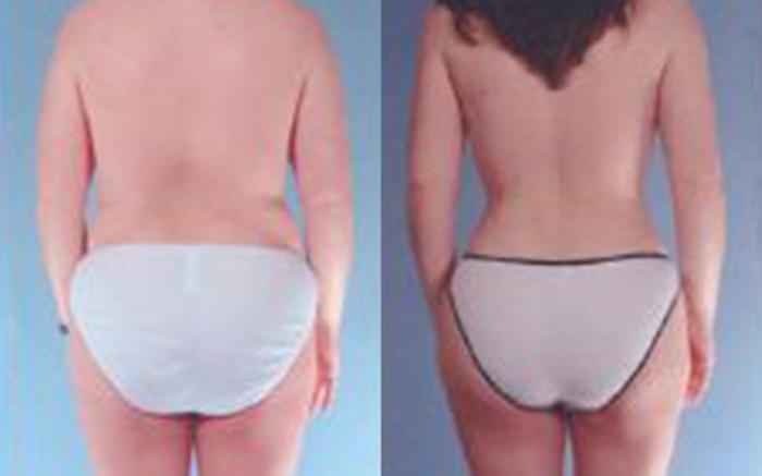 Before & After Liposuction Case 3537 View 4 View in Houston, TX
