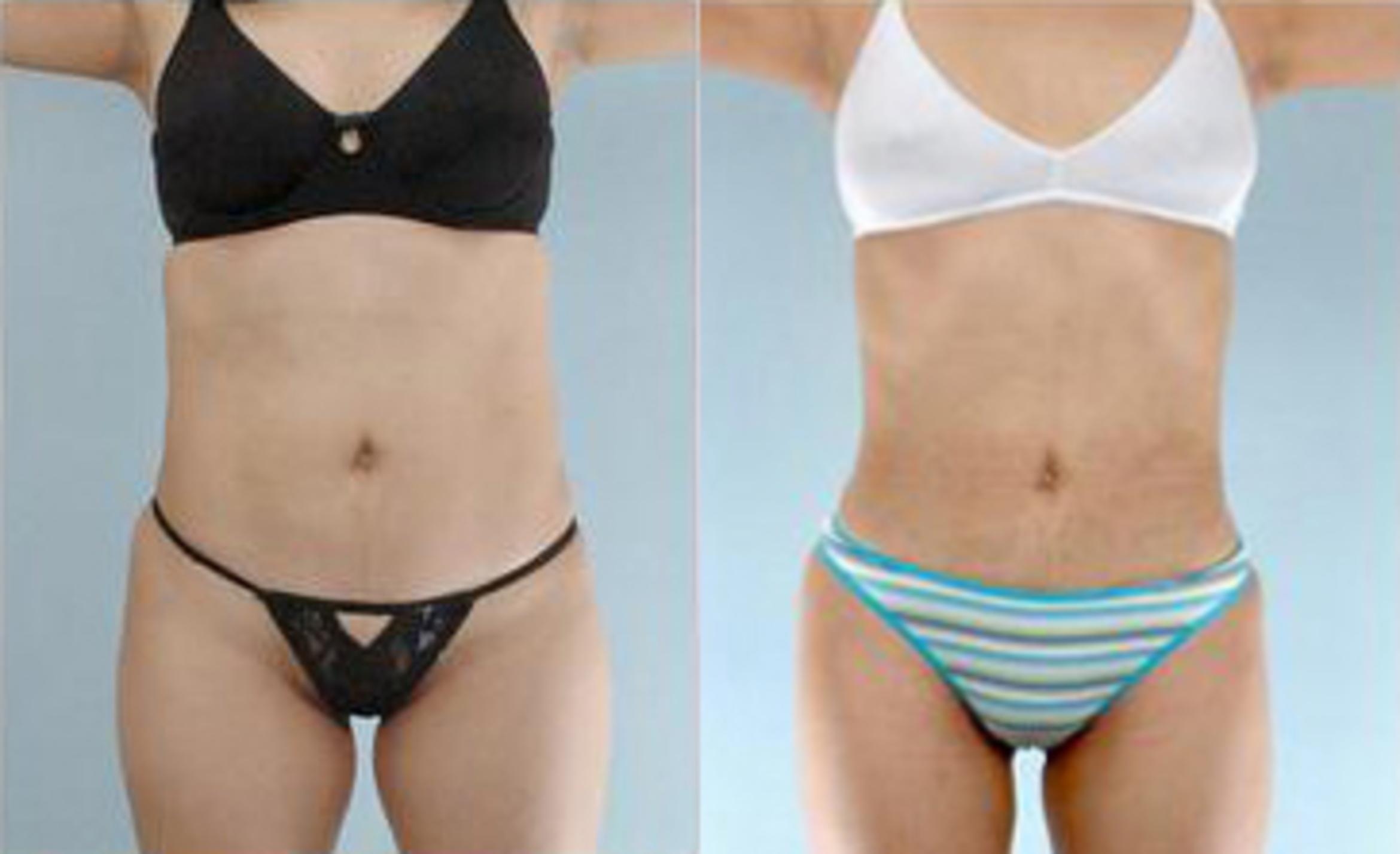 Before & After Liposuction Case 3547 View 1 View in Houston, TX