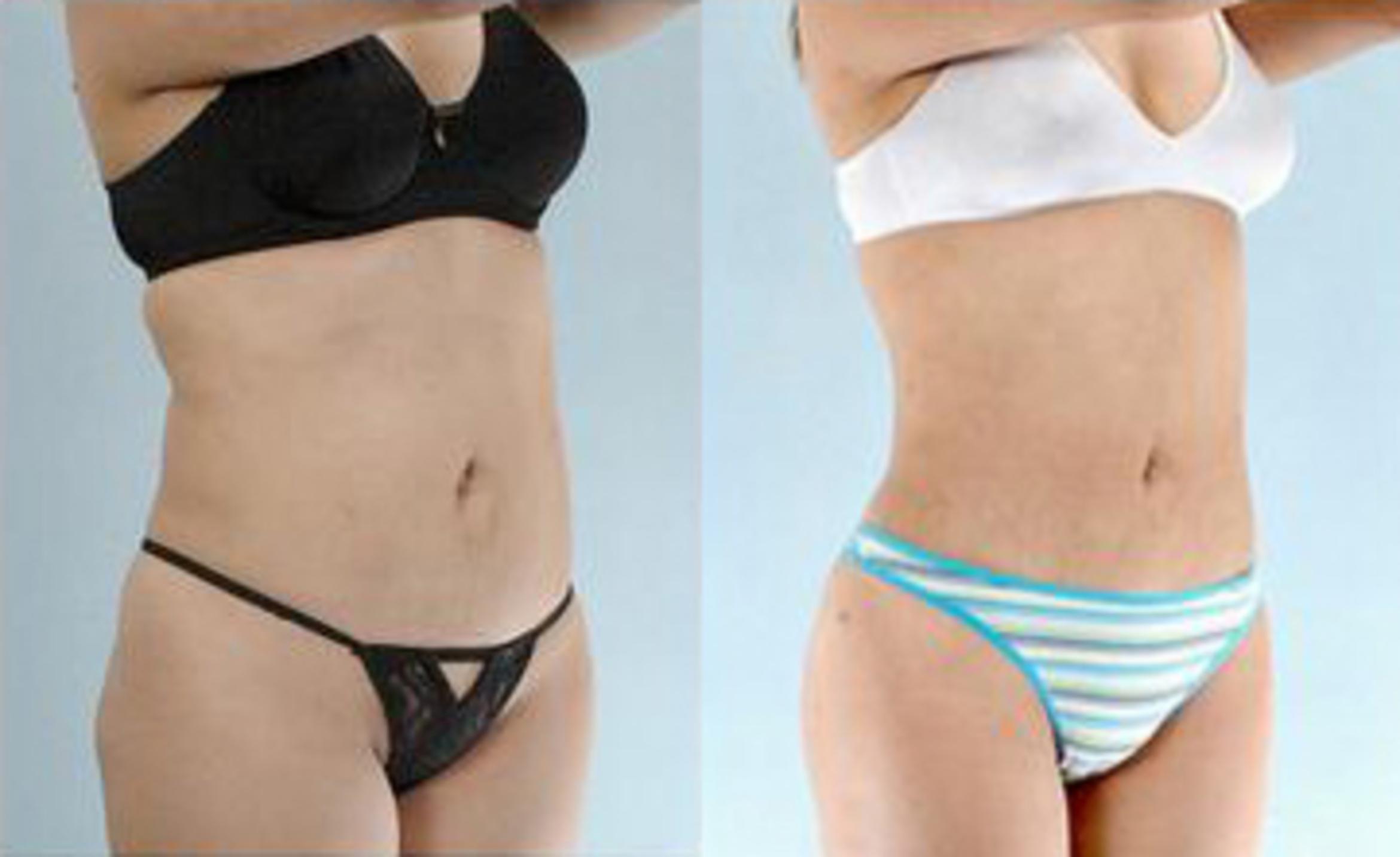 Before & After Liposuction Case 3547 View 2 View in Houston, TX