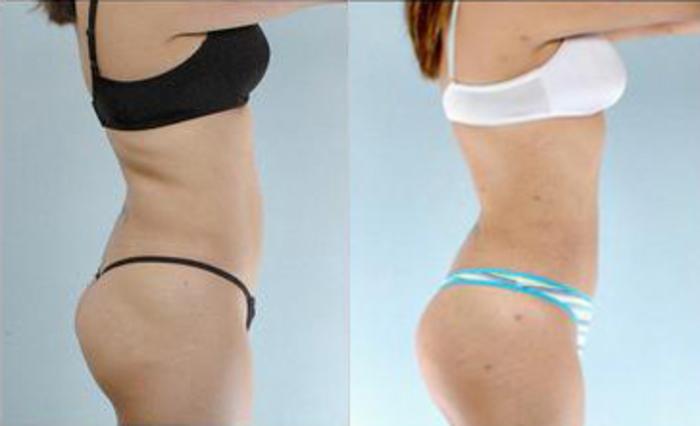Before & After Liposuction Case 3547 View 3 View in Houston, TX