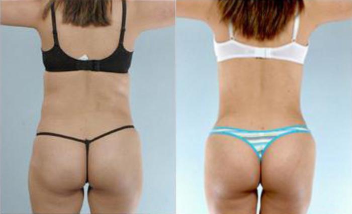 Before & After Liposuction Case 3547 View 4 View in Houston, TX