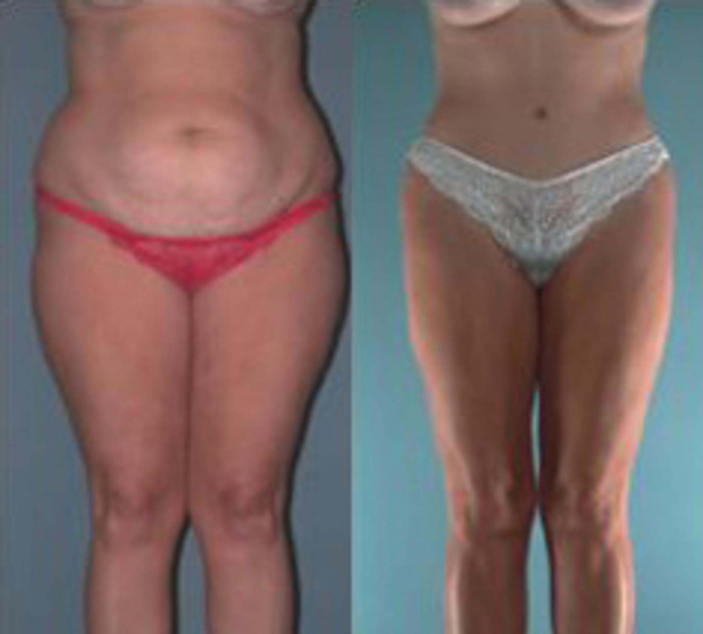 Before & After Liposuction Case 3557 View 1 View in Houston, TX