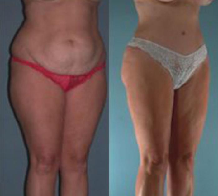 Before & After Liposuction Case 3557 View 2 View in Houston, TX