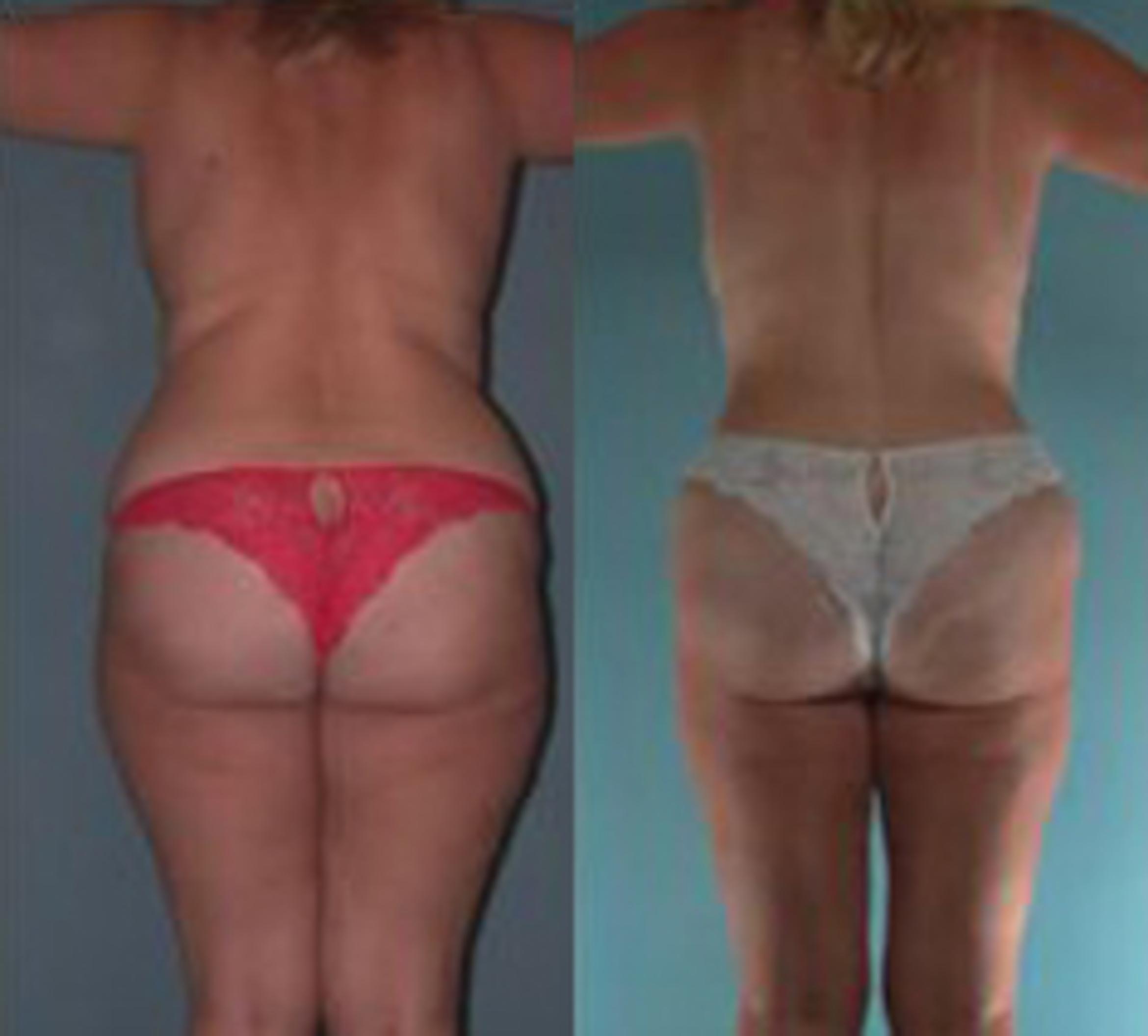 Before & After Liposuction Case 3557 View 3 View in Houston, TX