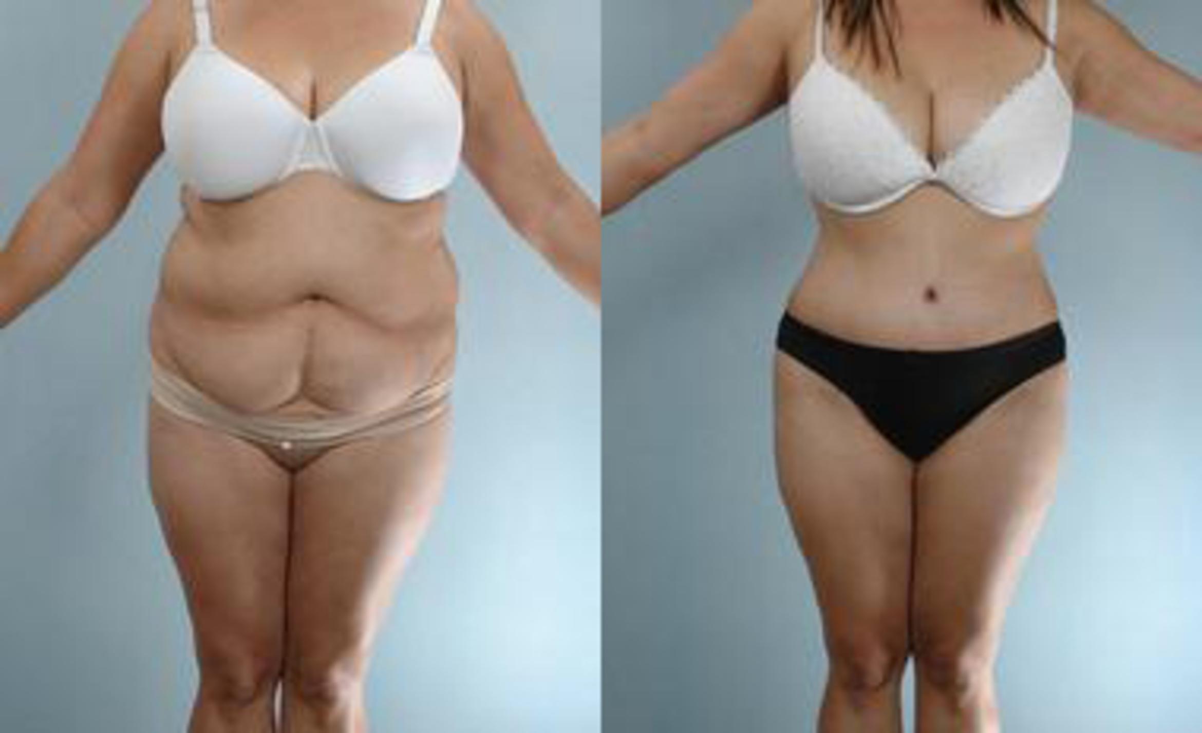 Before & After Liposuction Case 3565 View 1 View in Houston, TX