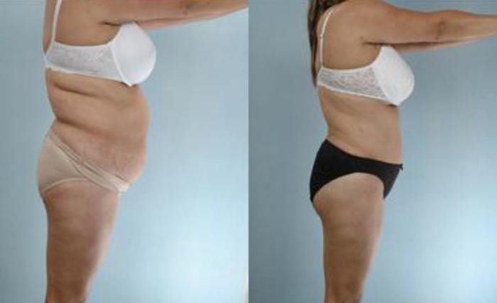 Before & After Liposuction Case 3565 View 3 View in Houston, TX