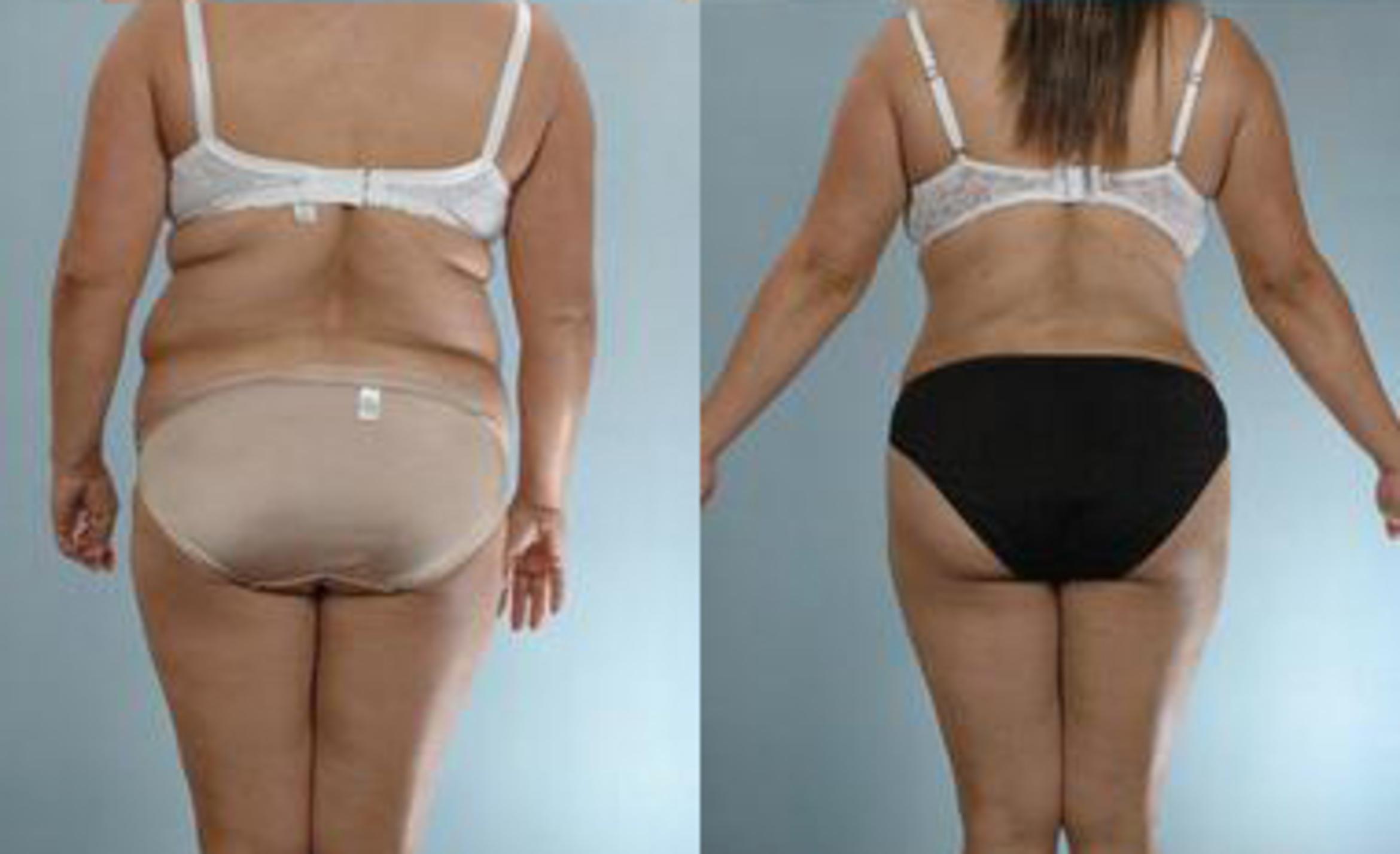 Before & After Liposuction Case 3565 View 4 View in Houston, TX
