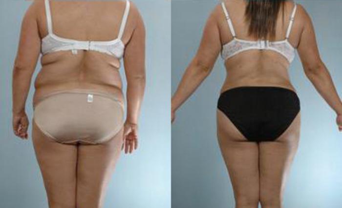 Before & After Liposuction Case 3565 View 4 View in Houston, TX
