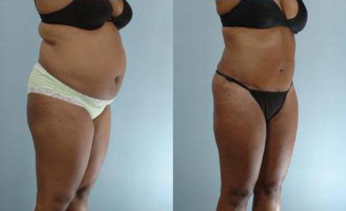Before & After Liposuction Case 3575 View 2 View in Houston, TX