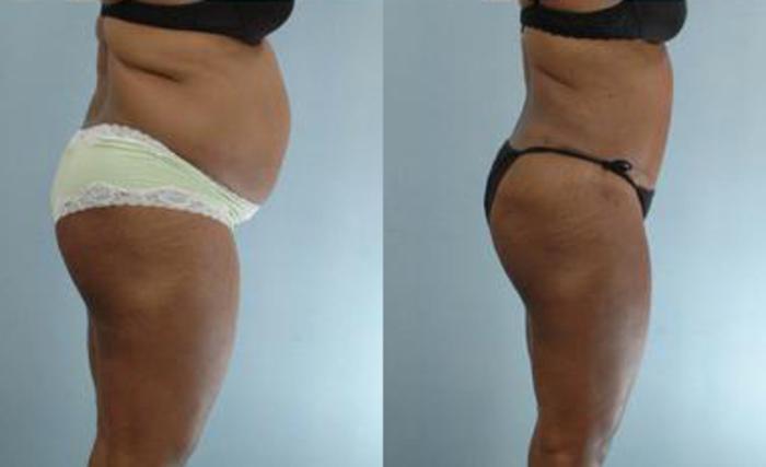 Before & After Liposuction Case 3575 View 3 View in Houston, TX