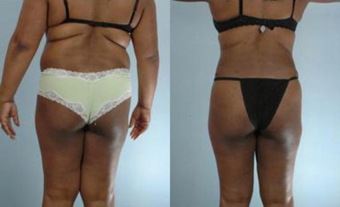 Before & After Liposuction Case 3575 View 4 View in Houston, TX