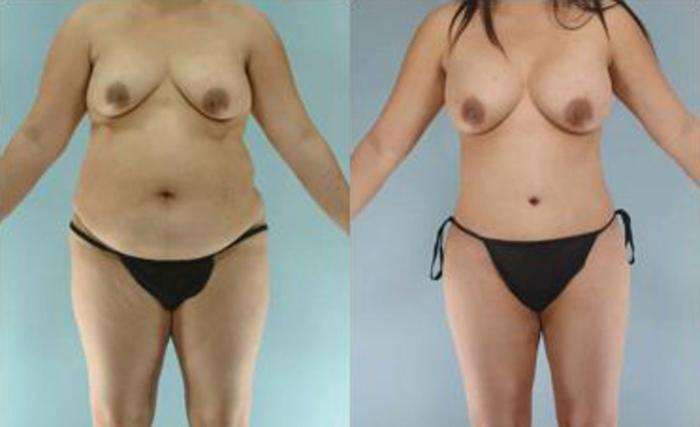 Before & After Liposuction Case 3585 View 1 View in Houston, TX