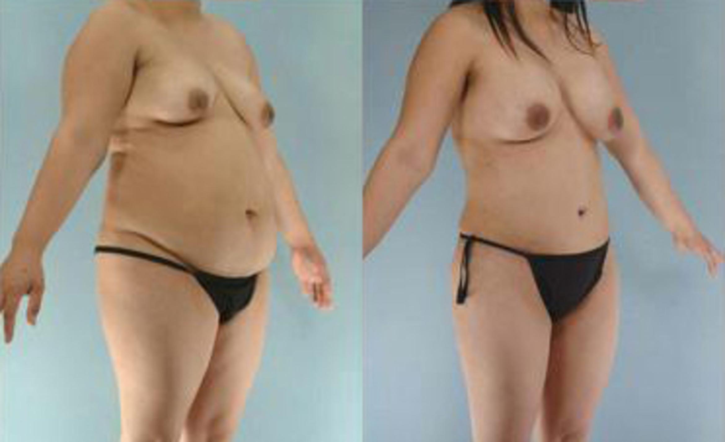 Before & After Liposuction Case 3585 View 2 View in Houston, TX