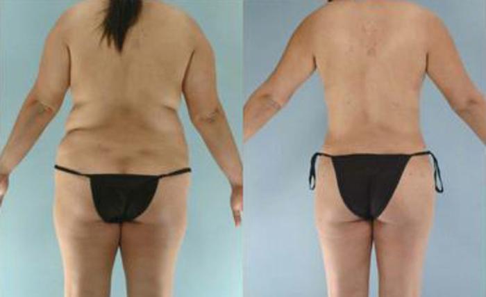 Before & After Liposuction Case 3585 View 4 View in Houston, TX
