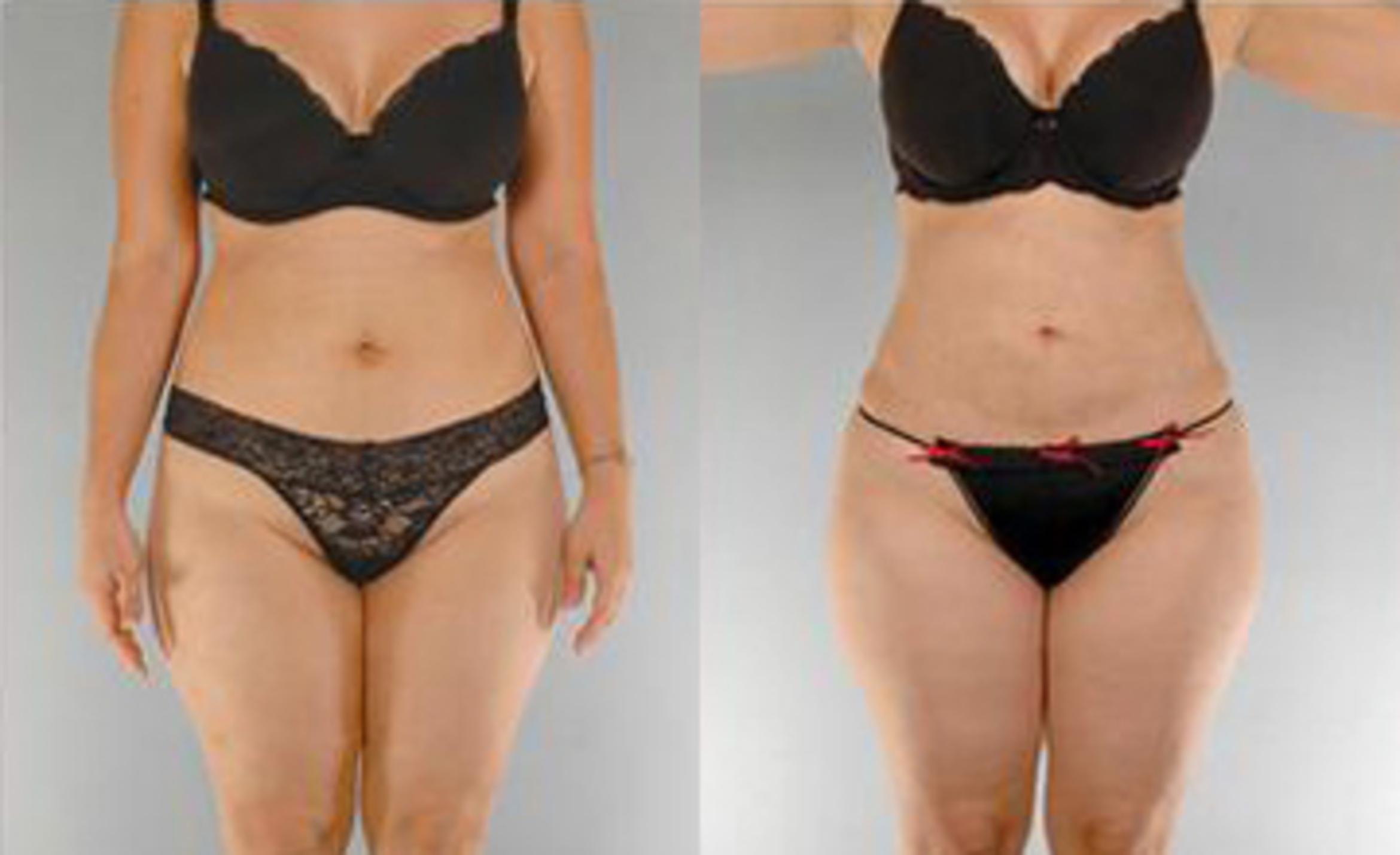 Before & After Liposuction Case 3595 View 1 View in Houston, TX