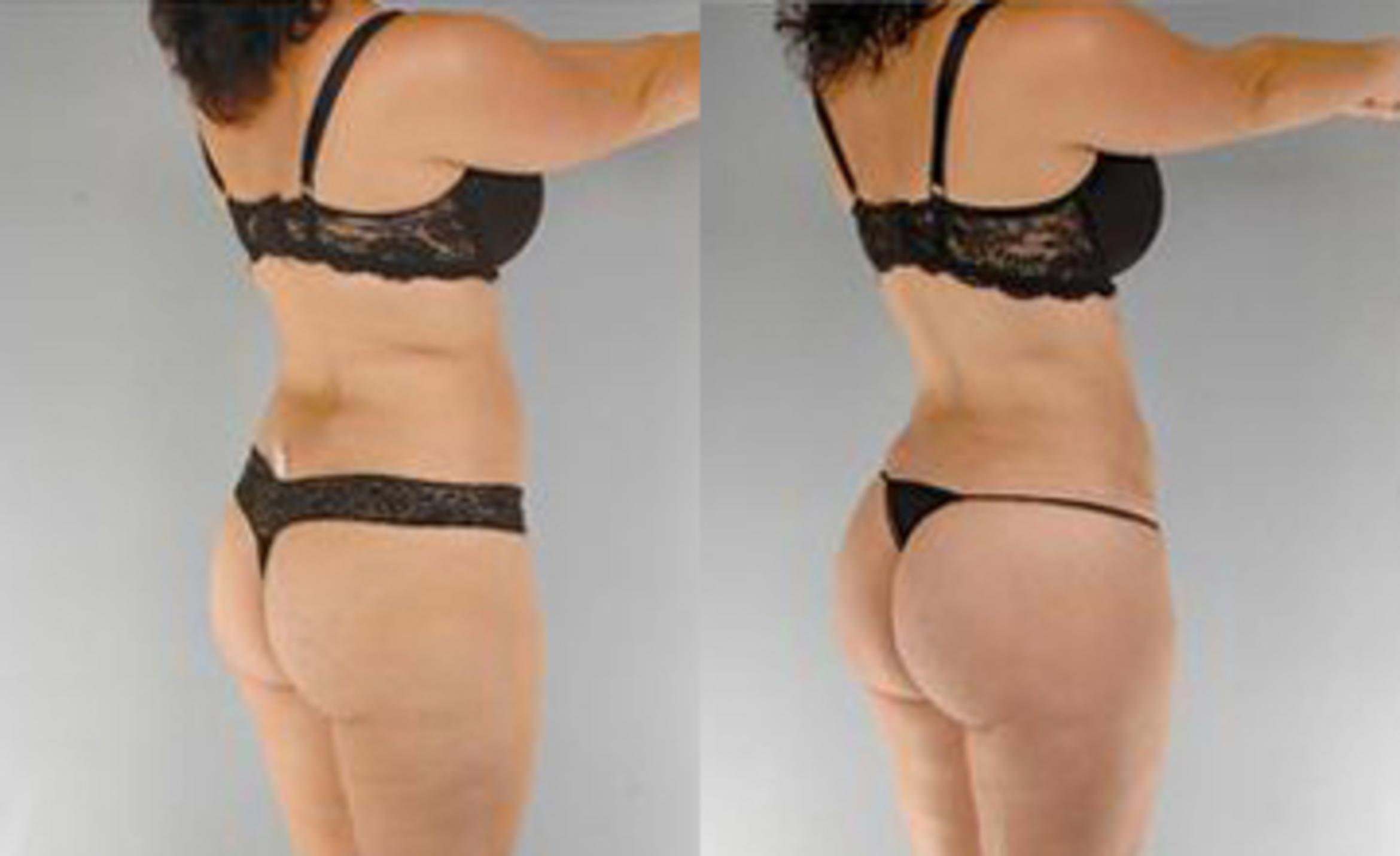 Before & After Liposuction Case 3595 View 2 View in Houston, TX
