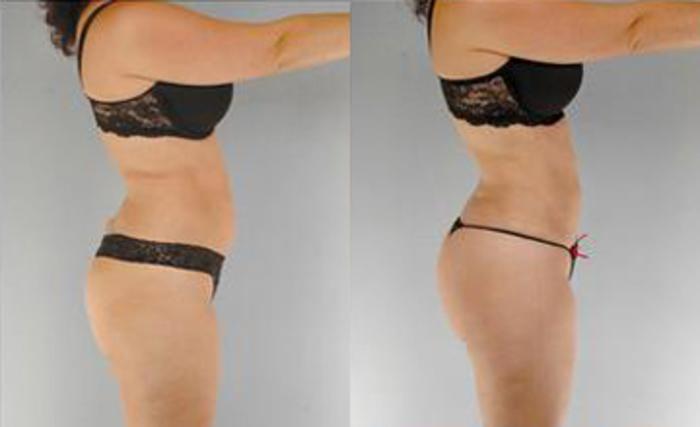 Before & After Liposuction Case 3595 View 3 View in Houston, TX