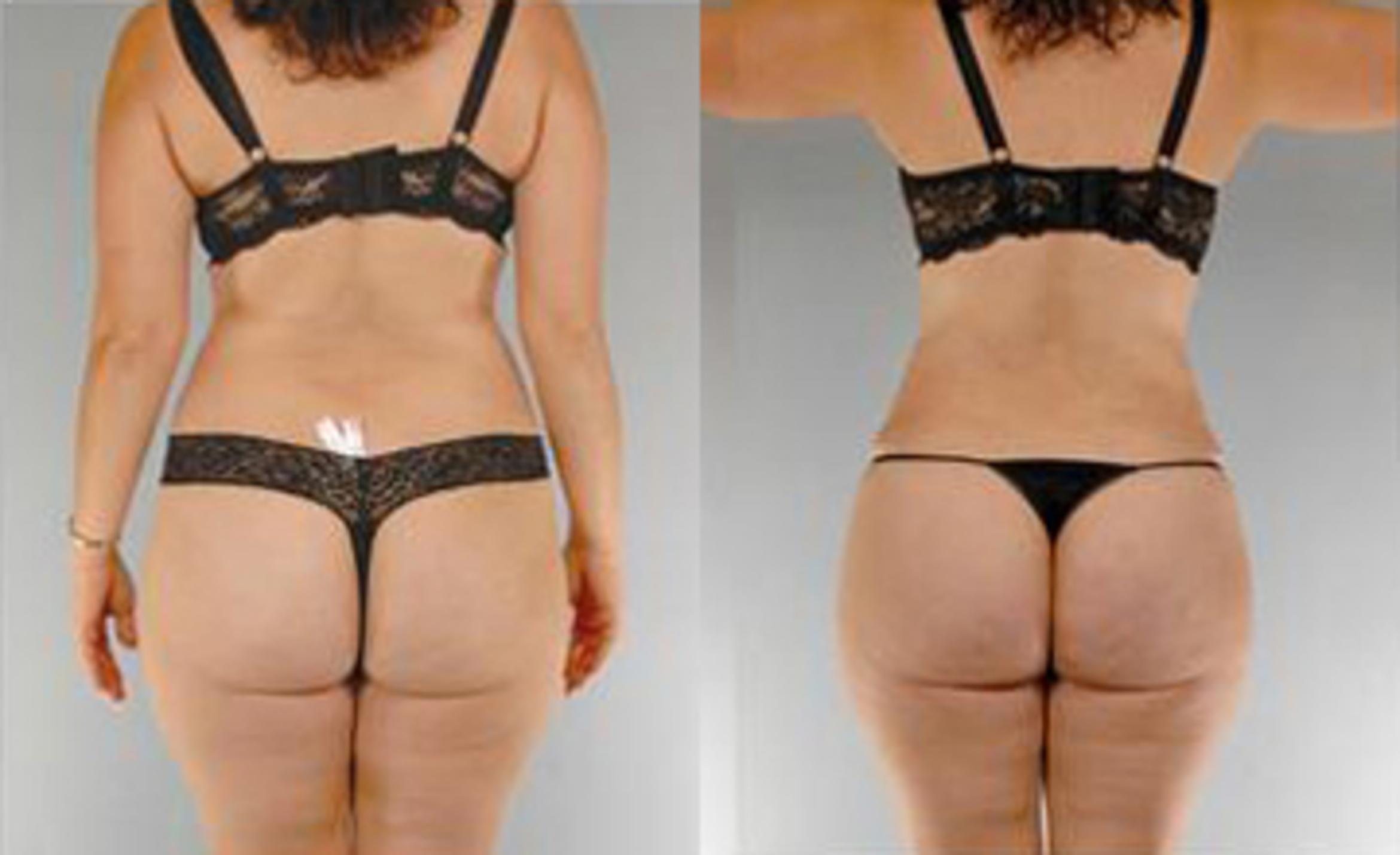 Before & After Liposuction Case 3595 View 4 View in Houston, TX