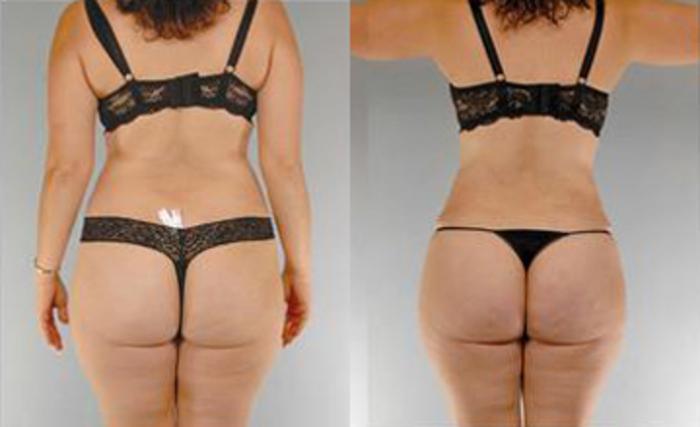 Before & After Liposuction Case 3595 View 4 View in Houston, TX