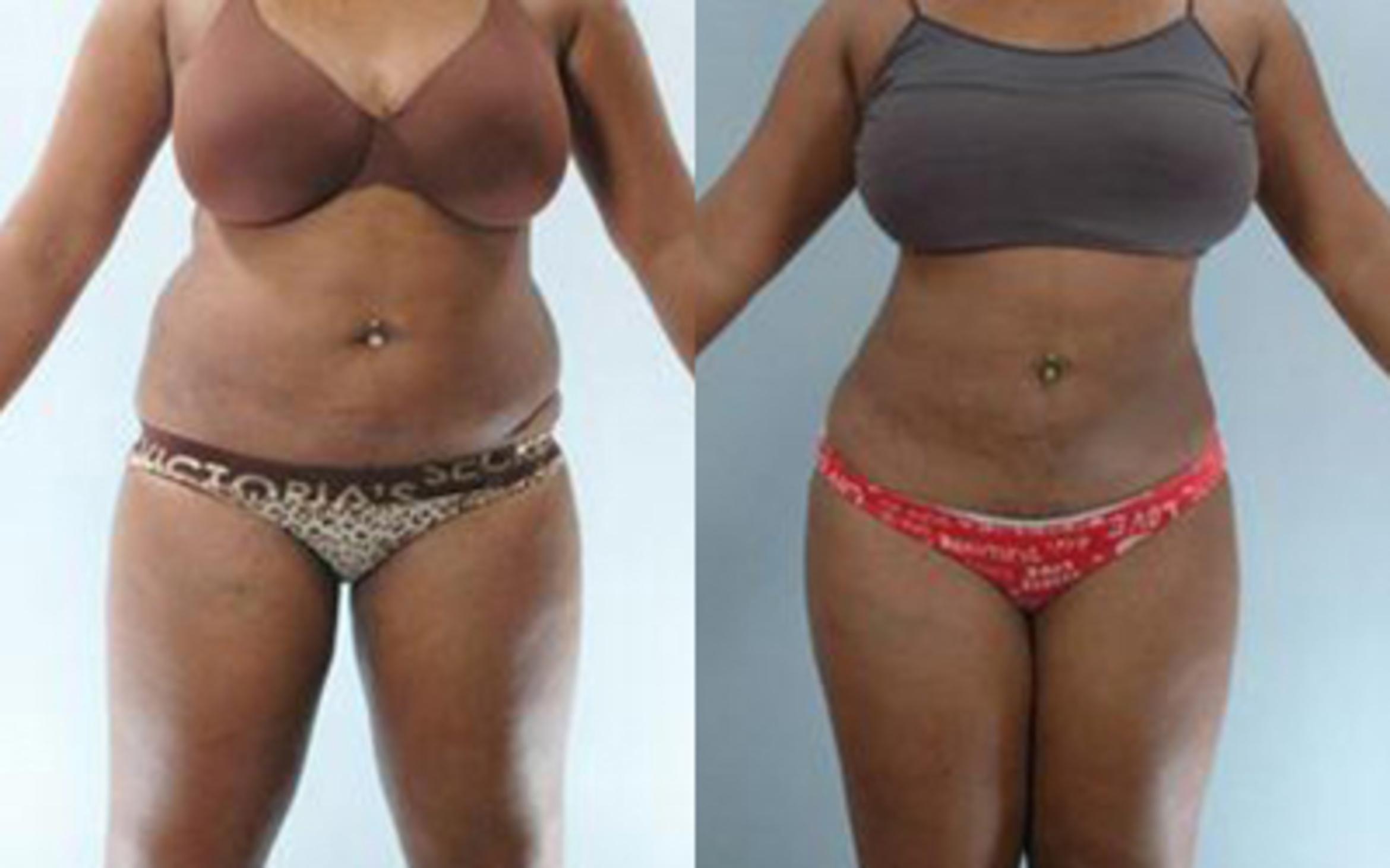 Before & After Liposuction Case 3605 View 1 View in Houston, TX