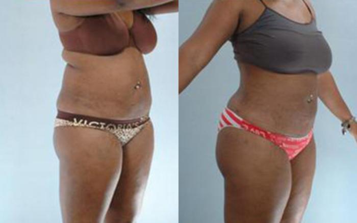 Before & After Liposuction Case 3605 View 2 View in Houston, TX