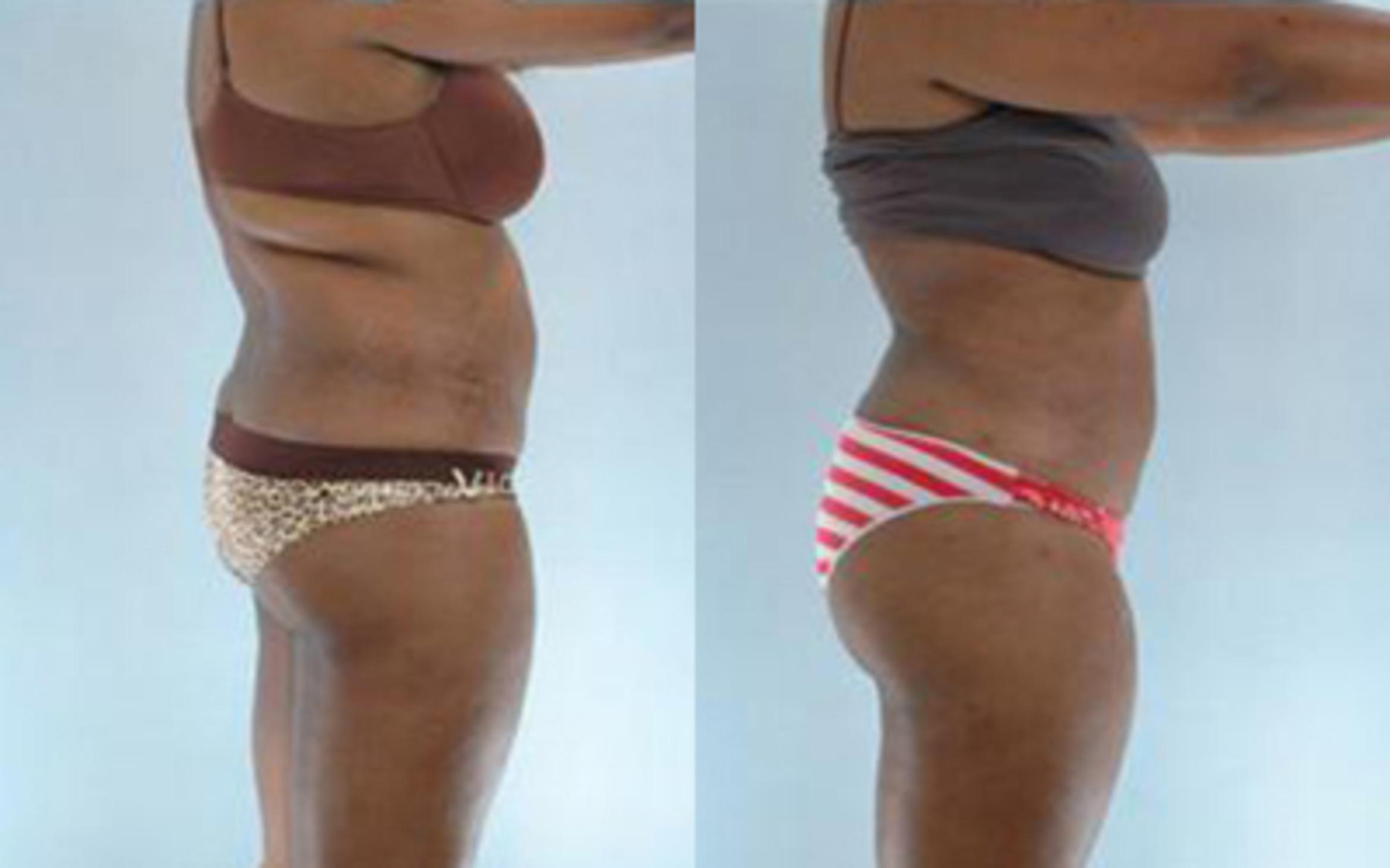 Before & After Liposuction Case 3605 View 3 View in Houston, TX
