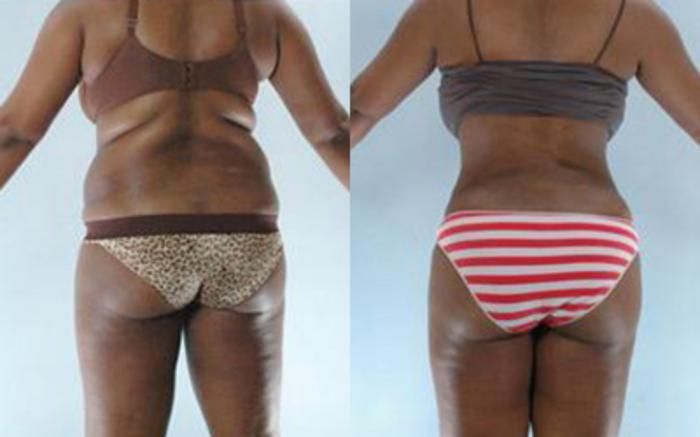 Before & After Liposuction Case 3605 View 4 View in Houston, TX
