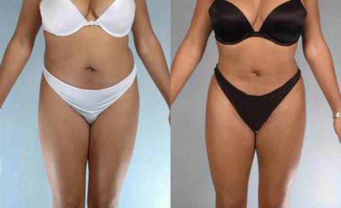 Before & After Liposuction Case 3615 View 1 View in Houston, TX