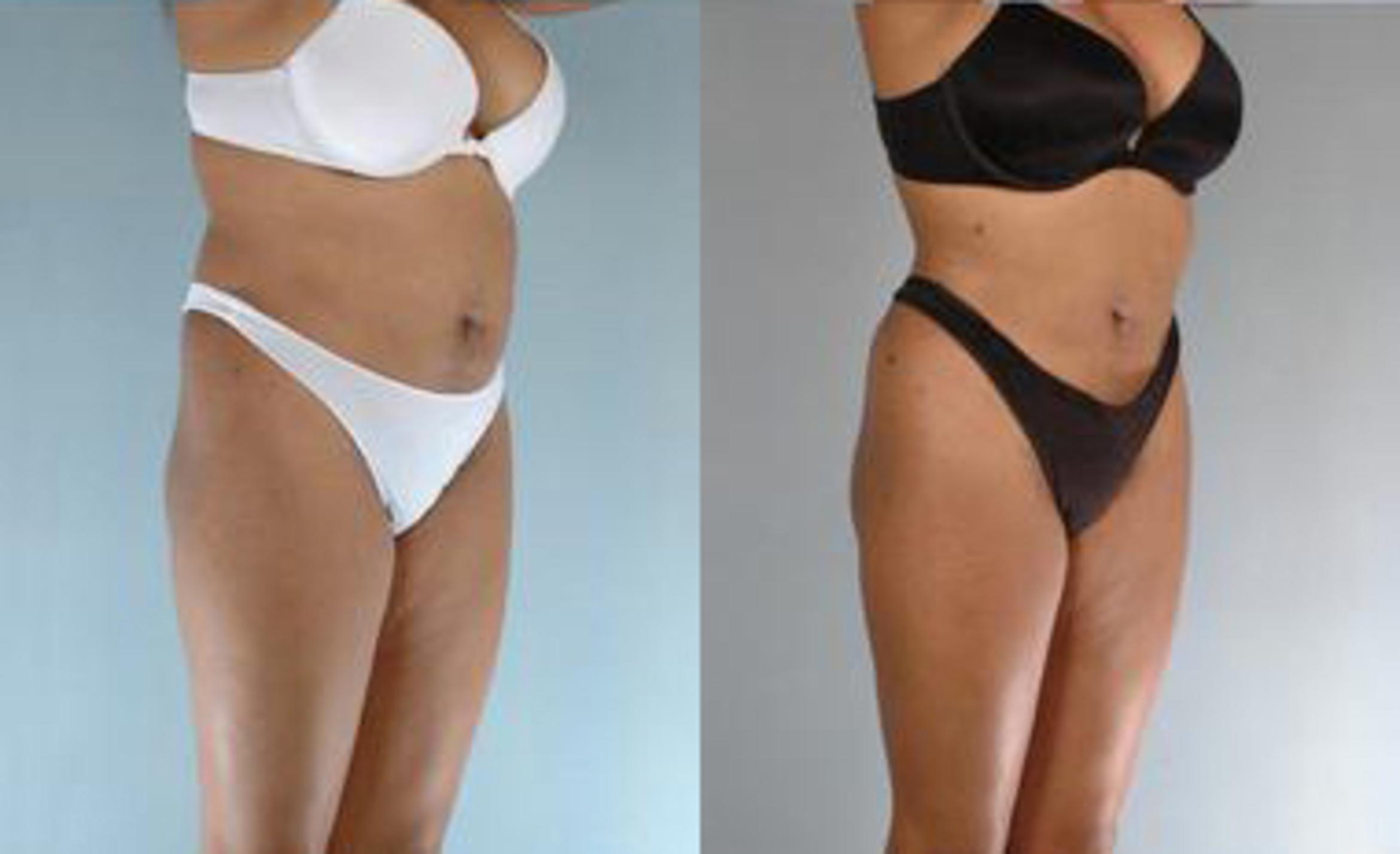 Before & After Liposuction Case 3615 View 2 View in Houston, TX