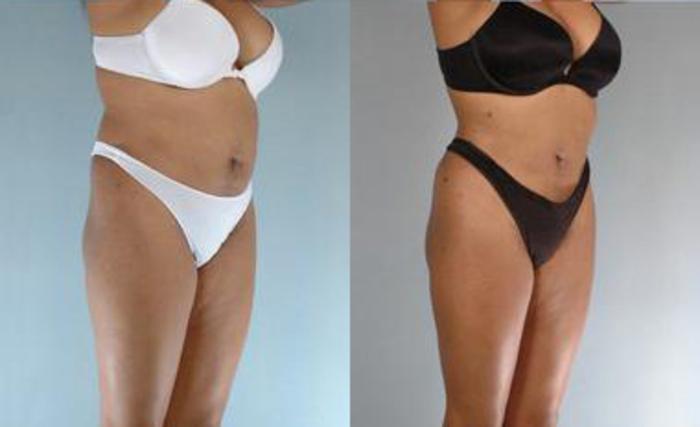 Before & After Liposuction Case 3615 View 2 View in Houston, TX