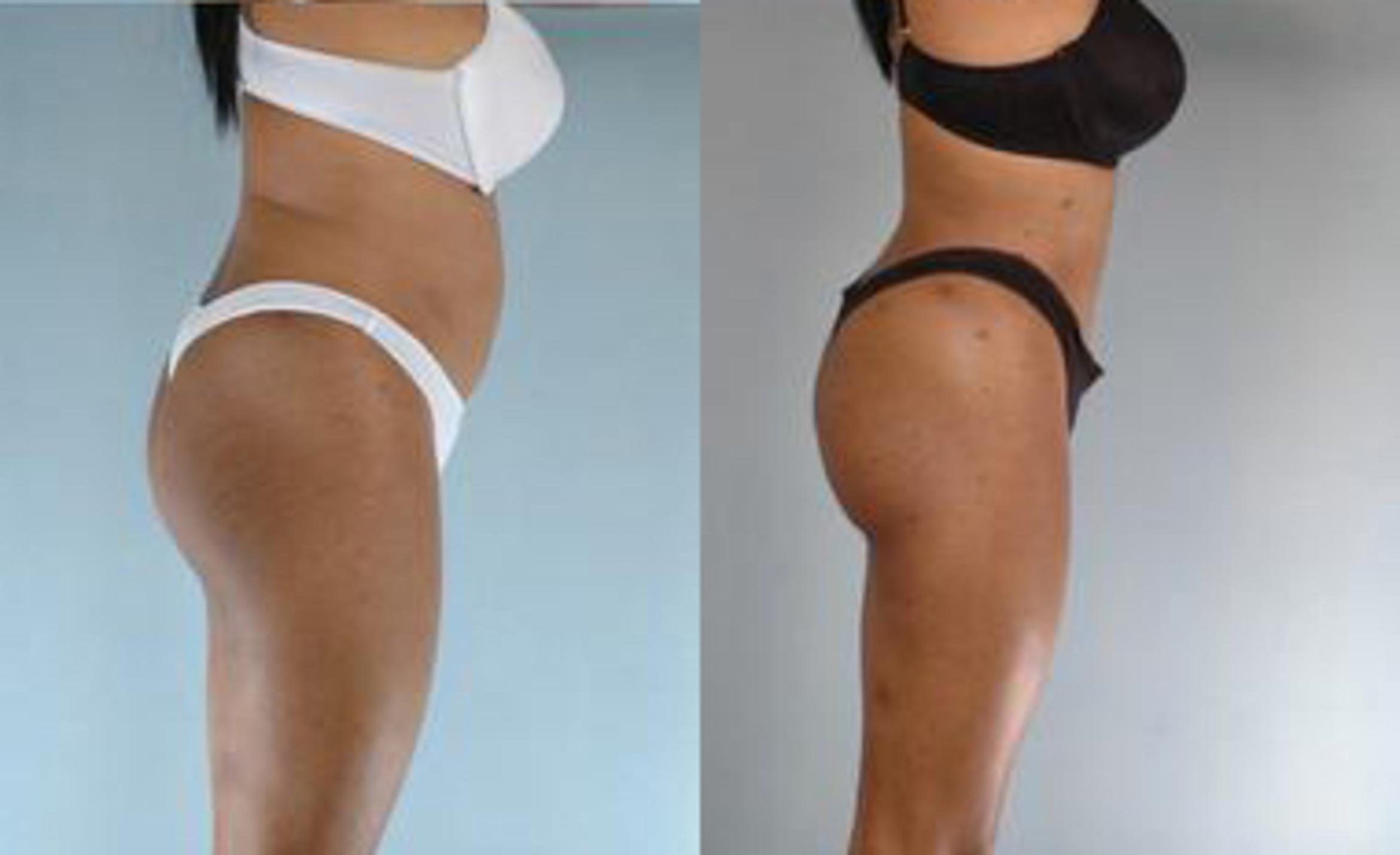 Before & After Liposuction Case 3615 View 3 View in Houston, TX